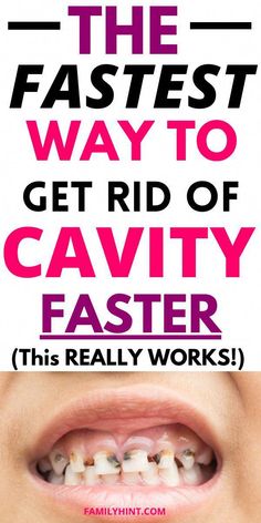 How To Get Rid Of Tooth Decay, Essential Oils For Cavities, Diy Cavity Repair, Reverse Cavity Naturally, Teeth Decay Remedies, How To Get Rid Of A Cavity At Home, Reversing Cavities Naturally, Healing Tooth Decay Naturally, Natural Tooth Decay Remedy