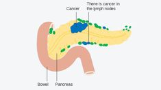 Welcome to the fascinating realm of battling Pancreatic cancer, where scientific warriors are deploying innovative strategies against a formidable foe. In this journey, we delve into the promising domain of HDAC Inhibitors and their extraordinary potential in piercing through the fibrotic shield that often obstructs conventional treatments. Understanding Pancreatic Cancer Let’s begin our exploration by … The post Unveiling the Battle Against Pancreatic Cancer: HDAC Inhibitors in F... Genetic Mutation, Cell Growth, Innovation Strategy, Abdominal Pain, Healthcare Professionals, Success Stories