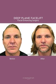 The Deep Plane Facelift is an advanced facelift that produces dramatic and rejuvenating results. One of Dr Yannis’ signature procedures, it ensures a striking transformation. Learn more and book your consultation - 111HarleyStreet.com The Deep