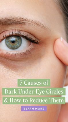 I'm often asked what causes dark under-eye circles so I want to share 7 common causes of dark under-eye circles and the solutions you can try to help reduce their appearance, naturally. #naturalremedies #naturalhealth #naturalbeauty #naturalskincare #holistichealth #wellness #skincare #eyehealth
#skin care routine #skincare product #bubble skincare Dark Under Eye Remedies, Dark Eye Bags Remedy, Natural Dark Circle Remedy Under Eyes, Essential Oil For Dark Circles Under Eye, No Dark Circles Under Eyes, How To Get Rid Of Undereye Dark Circles, Dark Eye Remedies, Foods For Dark Circles Under Eyes, Get Rid Dark Circles Under Eyes