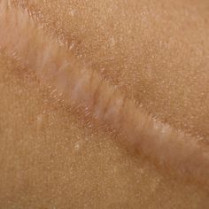 Keloids typically develop from three months to a year after the original skin damage but can occur at any time after the event. A rubbery scar tissue starts growing beyond the borders of the original damage. The keloid scar is raised above the surrounding skin and they are sometimes domed in appearance. #tuesdaythoughts Silicone Scar Sheets, Face Burn Scar, Scar Healing Stages, Cystic Acne On Chin, Gordale Scar, Tretinoin Cream, Skin And Hair Clinic, Face Care Routine, Acne Care