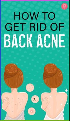 How To Get Rid Of Back Acne : Back acne is considered a moderately severe form of acne. While medical treatment is necessary, you can also supplement it with certain home remedies. Here, we have listed the top home remedies for back acne. You can follow them after consulting your health care provider. #skincare #backacne #skin #acne #remedies What Causes Back Acne, Remedies For Back Acne, Back Acne Causes, Get Rid Of Back Acne, Rid Of Back Acne, Back Acne Remedies, Cystic Acne Remedies, Back Acne, Forehead Acne