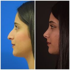 Natural Nose Job Rhinoplasty, Nostril Surgery, Pimple Inside Nose, Acne On Nose