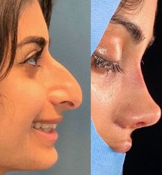 #plasticsurgery #plasticsurgerygonewrong #beforeafter #celebritiesbeforeafter #hollywoodstars #bignosesurgery #surgery #facesurgery #vlinesurgery #koreanplasticsurgery #kpopplasticsurgery #nosejob #jawreductionsurgery #eyesurgery #cheekfillers #rhinoplasty #facelift #plasticsurgeryfails #expensiveplasticsurgery Dream Nose, Dr Ali, Big Nose Beauty