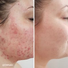 Micronidelling Face, Face Dark Spots, Facial Before And After, Before And After Acne, Cosmetic Web, Post Inflammatory Hyperpigmentation, Hydra Facial, Life Changing Skincare, Acne Solutions