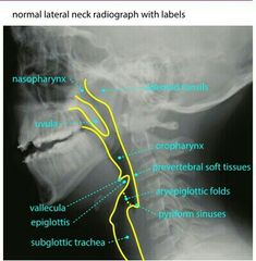 an x - ray shows the location of radiographs in the neck