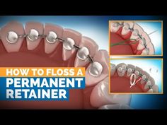 While kids are eager to be done with braces, the fact is, orthodontic retainers do as much work after braces come off, than the braces themselves. Teeth After Braces, Permanent Retainer, After Braces, Kids Braces, Extra Work, Perfect Smile, Cavities, Dental Care, Braces