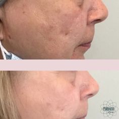 Diminish fine lines, reduce wrinkles, repair scarring, and tighten skin for a more youthful appearance. Call 859-444-8203 to schedule your #microneedling consultation today! . . #purevivemedspa #greatskin #beforeandafter #acnescar #skincare #antiaging Stubborn Acne, Acne Scarring, Tighten Skin, Reduce Acne, Before After Photo, React App, Scarring, Med Spa, Reduce Wrinkles