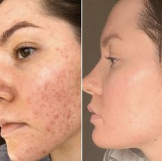 Aesthetics Practitioner, Back Acne Remedies, Blind Pimple, Skin Care Business, Dark Spots On Face, Natural Face Skin Care, How To Get Rid Of Pimples