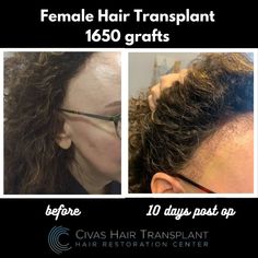 Hair Transplant Photos | Civas Hair Transplant