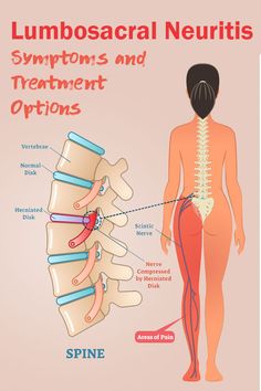 Psoas Iliaque, Sciatic Nerve Pain Relief, Sciatica Stretches, Bolesti Chrbta, Sciatica Exercises, Sciatica Pain Relief, Spine Health, Nerve Pain Relief