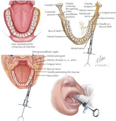 Nerves Anatomy, Cranial Nerves Anatomy, Anatomy Dental, Dental Assistant Study Guide, Trigeminal Nerve, Dental Assistant School, Dental Assistant Study, Dental Hygiene Student, Dental Extraction