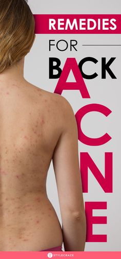 Back Acne, Acne Prone Skin Care, Lotion For Oily Skin, Home Remedies For Acne, Body Acne, Skin Care Wrinkles, Baking Soda Shampoo