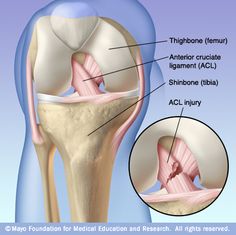 Great description of an ACL tear.  The anterior cruciate ligament (ACL) is one of the key ligaments that helps stabilize your knee joint. The ACL connects your thighbone (femur) to your shinbone (tibia). It's most commonly torn during sports that involve sudden stops and changes in direction — such as basketball, soccer, tennis and volleyball. Acl Injury, Acl Recovery, Acl Surgery, Anterior Cruciate Ligament, Ligament Tear, Acl Tear, Ligament Injury, Cruciate Ligament, Knee Pain Relief