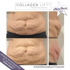 The client hated her stomach after having two children, and was desperate for something to help her. After descovering SkinBase Collagen Lift, she was hoping some of the sagging would be taken away. She is so impressed with the results after just six sessions. Radio Frequency, Face And Body