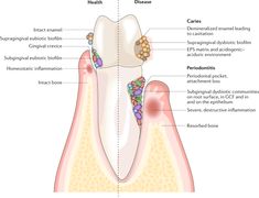 The dynamic and polymicrobial oral microbiota is a direct precursor of diseases such as dental caries and periodontitis. In this Review, Lamont, Koo and Hajishengallis discuss the mechanisms by which oral microbial communities develop and become functionally specialized. They also examine the progression of polymicrobial communities towards pathogenicity. The Mechanisms, Candida Albicans, Gut Microbiota, Bone Loss, Periodontal Disease, Immune Response, The Collective, Microbiology, Oral Health