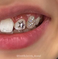 a close up of a person's teeth with clear braces and crystal stones