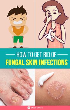 Fungal Infection Remedies, Fungal Infection Skin, Nail Fungus Remedy, Skin Care Routine For 20s, Nail Infection, Infection Prevention, Fungal Nail, Bacterial Infection, Fungal Infection