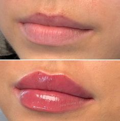 Lip Filler Reference Photos, Natural Russian Lips, Natural Looking Lip Injections, Lip Fillers Natural Look, Lip Filler Lips, Julie Horne Lip Filler, Lip Botox Natural, Kysse Lips Filler