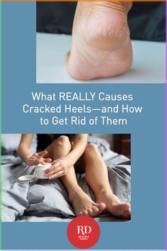 Fix your cracked heels with these expert tips and products and you'll be wearing those summer sandals with confidence. #crackedheels #skincare #dryskin Sunburn Peeling, Dry Cracked Heels, Heel Care, Dry Heels, Natural Face Care, Silky Skin, Perfect Skin Care Routine, Cracked Heels, Cold Sore