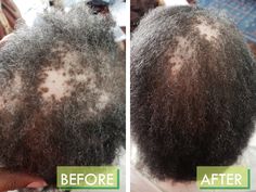 Don't give up on growing your own great hair. Now with our RENEWAL+ Growth Complex. Our unique blend of herbal plant ingredients promote healthier, thicker, and more lush hair after only 30 days of use. Just look at our many before and after pictures. Field trials have shown great results on those who advised that they suffer from long term post partum alopecia, alopecia areata, and early female pattern baldness. Use along with our Heal & Grow Botanical Oil for great results. Results may vary. ? Hair Growth Regimen, Lush Hair, Growing Facial Hair, Hair Regrowth Women, Alopecia Hairstyles, Female Pattern Baldness, Herbal Plants, Hair Regrowth Treatments, After Pictures