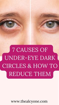 Got under eye dark circles and you don't know why? Then read this post to get the top 7 reasons why you may have dark circles under your eyes and what to do about it Under Eye Dark Circles, Dry Under Eyes, Eye Dark Circles, Dark Circles Around Eyes, Skin Lightener, Oily Skin Care Routine, Under Eyes, Dark Under Eye