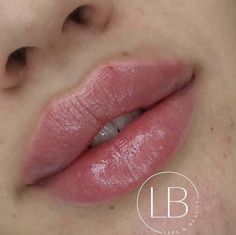 Pillow Lips Injections, Keyhole Lips, 1ml Lip Filler, Juvederm Lips, Heart Lips, Heart Shaped Lips, Face Surgery