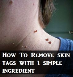 How To Remove Skin Tags With One Simple Ingredient... ACV - Apple Cider Vinegar Cut a tiny square of cotton pad to cover the tag and soaked it in organic apple cider vinegar and then used a band aid to secure and left over night. Repeat if necessary. Results: Skin tag turned black and fell off in about 3-5 days with no bleeding and no scarring. Remedies For Skin, Remove Skin Tags, Home Remedies For Skin, Skin Tags, Health And Beauty Tips, Short Cuts, Health Remedies, Natural Healing, Herbal Remedies