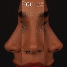 Discover perfection in symmetry with rhinoplasty precision. Our surgeons meticulously craft noses that achieve balance and harmony, enhancing your facial aesthetics. Explore rhinoplasty precision for facial symmetry today! Symmetry Face, Facial Symmetry, Ethnic Rhinoplasty, Nose Jobs, Botox Filler