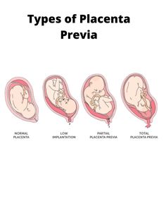 the types of placanta previa