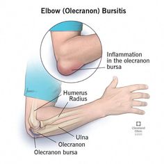 Elbow bursitis is painful swelling around your elbow joint. It’s inflammation in the olecranon bursa — the fluid-filled sac that surrounds and protects your elbow. Elbow Bursitis, Bursitis Elbow, Tennis Elbow Symptoms, Golfers Elbow, Elbow Pain, Inflammation Causes, Health And Fitness Magazine, Tennis Elbow, To Touch