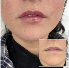 Before and after lip filler, we gave this lovely patient some volume and kept her lips looking natural Lips