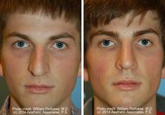 Wide nasal bones Face Lift, A Face