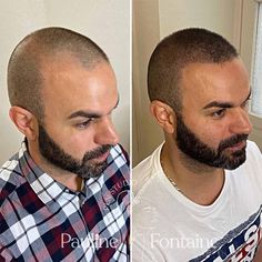 Scalp Micropigmentation Women, Haircuts For Balding Men, Scalp Tattoo, Bald With Beard, Celebrity Plastic Surgery, Bald Hair, Bald Men