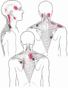 For neck and shoulder pain treatment, in addition to correcting any postural… Neck Muscles, Neck Exercises, Neck And Shoulder Pain, Muscle Strain, Trigger Points, Shoulder Pain, Reflexology, Neck Pain