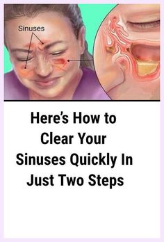 One cause of sinus infections is a result of bacterial invasion within one or more of the sinus cavities..
#remediesforgumpain Acute Sinusitis, Remedy For Sinus Congestion, Clear Your Sinuses, Home Remedies For Sinus, Sinus Congestion Relief, Sinus Cavities, How To Clear Sinuses, Congestion Relief, Sinus Pressure