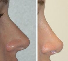 Celebrity Noses, Acne On Nose, Japanese Sun, Sun Hoodie, Nose Reshaping, Rhinoplasty Surgery