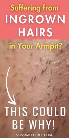 One of the things that surprises my patients who suffer from ingrown hair in the armpit is the link to deodorant. Here we will discuss the causes of ingrown hair, ingrown hair treatment remedies, ingrown hair armpit home remedies, armpit pain causes, why is deodorant bad for you, bad deodorant ingredients, best DIY deodorant+ natural, deodorant side effects, hidranitis suppurativa, deodorant irritation, allergic reaction to deodorant, really bad ingrown hair, how to get rid of ingrown hair in armpit, underarm skin care routine, deodorant tips, ingrown hair prevention, skin health tips, and the best safe deodorant.