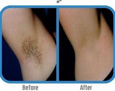 Remove Unwanted Hair, Underarm Hair Removal, Hair Removal Permanent, Beauty Remedies, Hair Removal Cream, Unwanted Hair Removal, Hair Remover, Unwanted Hair, Homemade Beauty Products