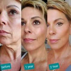 Neck Lift Surgery, Local Anesthesia, Face Lift Surgery, Green Tea Face, Facial Contouring, Neck Lift, Facial Plastic, Laser Skin, Housewives Of Beverly Hills