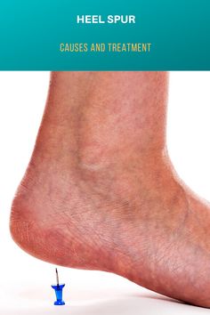 Exercises For Heel Spur, Foot Spurs Remedies Heel Pain, Heel Spur Relief Exercise, Bone Spur Heel, Heel Spur Relief Remedies, Bone Spur Remedies, Heal Spur Remedies, Heal Spurs, Heel Spur Relief