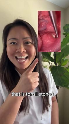 Get to the root of bad breath ! Tonsil stones are a leading cause of halitosis. Discover all products of Oravix. Tonsil Stones Removal, Tonsil Stone, Strong Teeth, Blood Sugar Diet, Dark Underarms, Stronger Teeth, How To Prevent Cavities, Healthy Advice