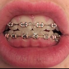 Braces Pink, Natural Teeth Whitening Diy, Adult Braces, Membentuk Alis