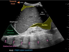 Abdomen Ultrasound, Ultrasound Tech