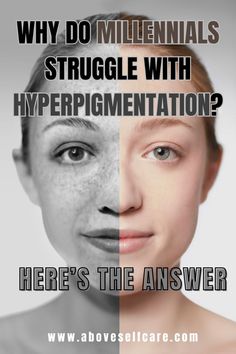 millennials stuff | millennials beauty | hyperpigmentation | hyperpigmentation how to get rid of it | how to get rid of it hyperpigmentation | hyperpigmentation serum | hyperpigmentation treatment | hyperpigmentation mask | hyperpigmentation on face | hyperpigmentation upper lip | black spots | how to get rid of black spots | sun damage skin | upper lips darkness remove | upper lip darkness how to remove | millennials problems | millennial  millennials skin | dark spots on skin | dark spots on face remedies | Dark Spots On Face Remedies, Hyperpigmentation On Face, Face Hyperpigmentation, Hyperpigmentation Mask, Spots On Skin, Hyperpigmentation Serum, Face Remedies, Upper Lips, Dark Spots On Face