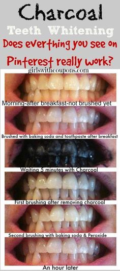 Get Rid of Cavities and Tooth Decay - Discover holistic secrets for strong teeth and gums by Beverly Oneil Brushing With Baking Soda, Baking Soda Toothpaste, Lung Cleanse, Charcoal Toothpaste, Skin Moles