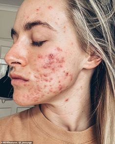 Painful Acne, Bad Acne, Positive Images, Peeling Skin, Acne Free