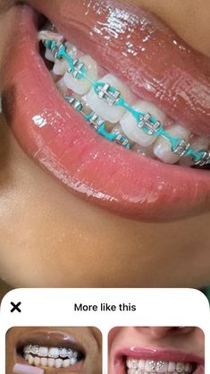 Cute Color For Braces, Teal Braces For Teeth, Braces Sky Blue, Braces Light Blue, Bright Braces Colors, Blue Braces Aesthetic, Braces Rubber Bands Colors