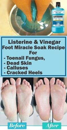 Listerine Foot Soak, Foot Soak Recipe, Cracked Heels, Foot Soak, Toenail Fungus, Beauty Remedies, Foot Care