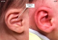 The conchal crus is a part of the ear’s cartilage structure, located in the conchal bowl, which is the deep, bowl-shaped part of the external ear. A conchal crus ear deformity occurs when there is an abnormality in this cartilage, which can manifest as:
- An extra ridge or fold in the ear cartilage
- A misshapen or prominent conchal crus
- Asymmetry between the ears

Such deformities may be congenital (developing in the womb) or may have a genetic component influencing the ear cartilage, says our facial plastic surgeon Dr. Inessa Fishman, MD. Early intervention with EarWell ear molding and surgical options like otoplasty can correct this cartilage abnormality. Ear Parts